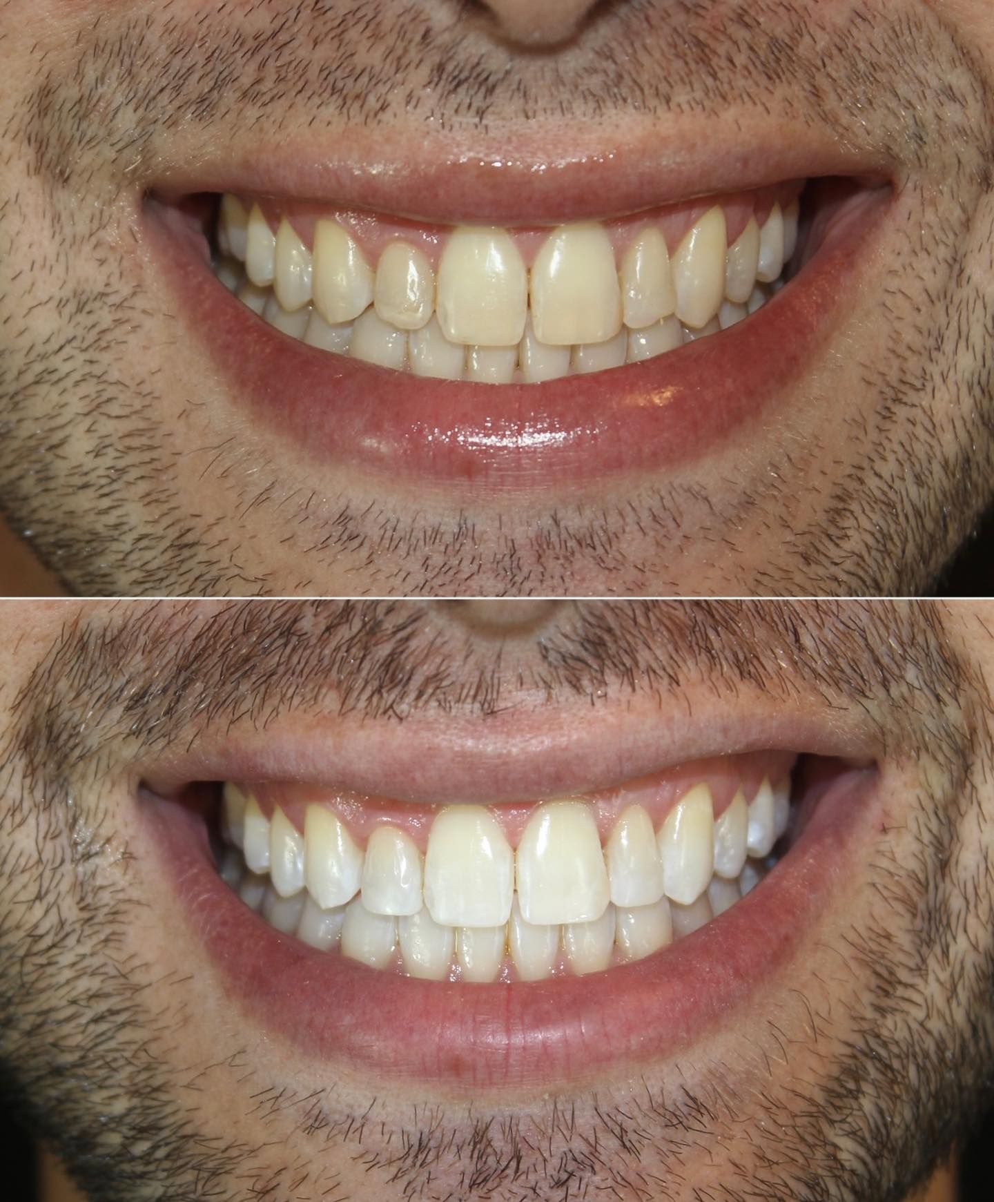 Resultado de tratamento odontológico — antes e depois