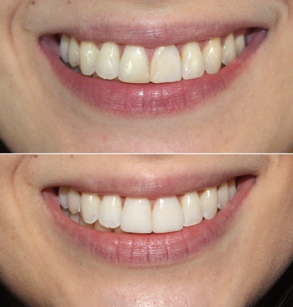 Resultado de tratamento odontológico — antes e depois
