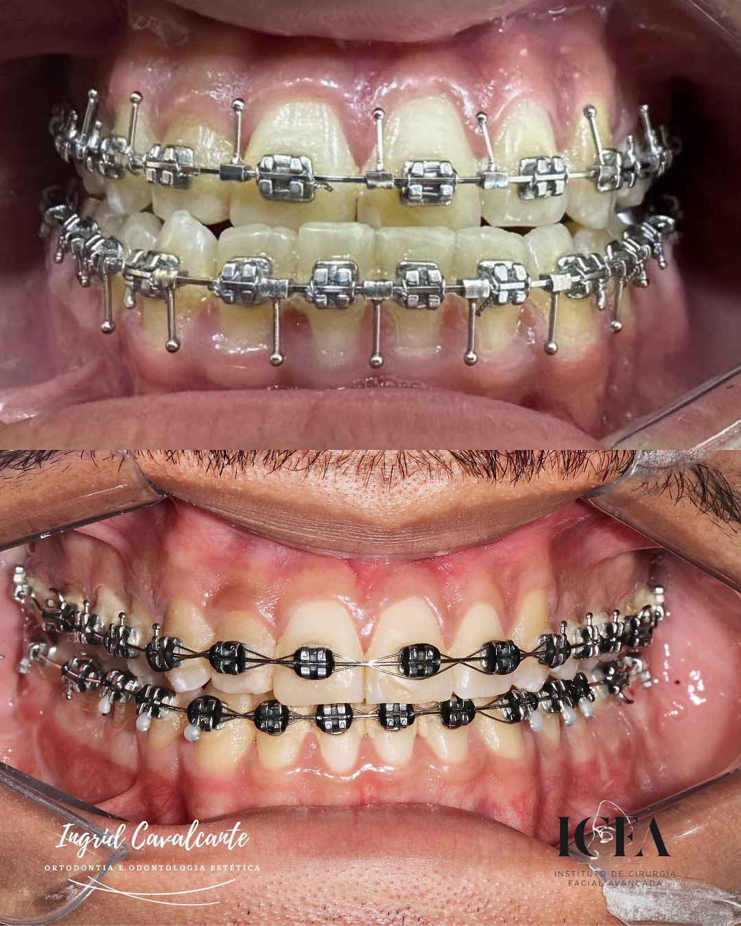 Resultado de tratamento odontológico — antes e depois